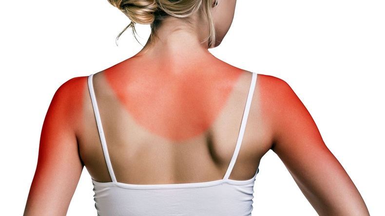 Sunburn female shoulder
